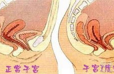 小姐姐耻骨复位,小姐姐的骨盆健康守护之旅